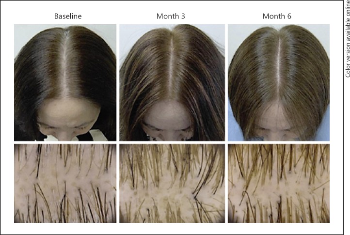 Nanoxidil 與 Minoxidil的比較 @董哥的家 iwanthair&#039;s blog