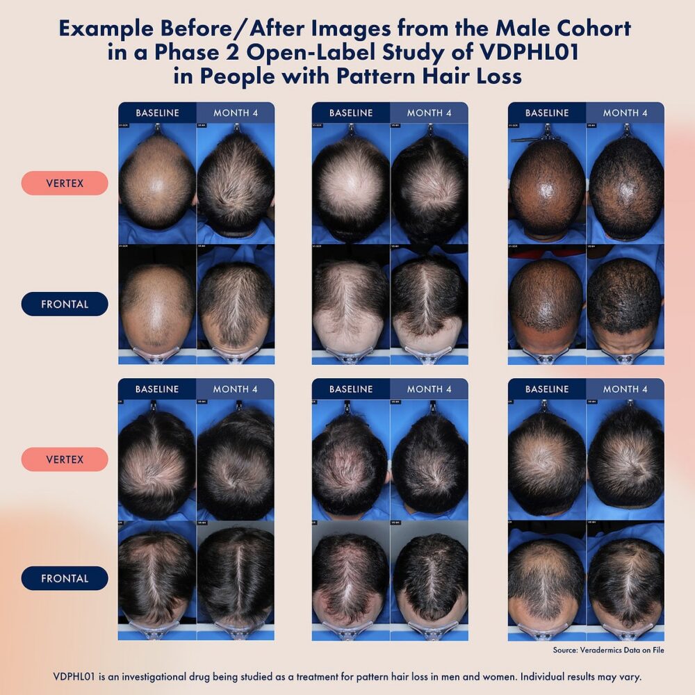 米糠油生髮？ @董哥的家 iwanthair&#039;s blog