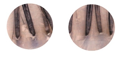 濕疹藥物Dupilumab讓圓禿患者的頭髮重新生長 @董哥的家 iwanthair&#039;s blog
