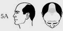 Dutasteride（Avodart）已著手進行治療雄性禿掉髮的第三階段臨床實驗 @董哥的家 iwanthair&#039;s blog