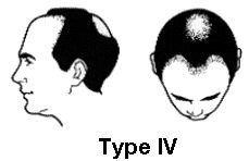 Dutasteride（Avodart）已著手進行治療雄性禿掉髮的第三階段臨床實驗 @董哥的家 iwanthair&#039;s blog