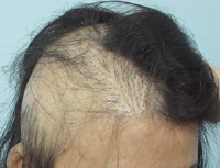 疤痕性禿頭的治療 @董哥的家 iwanthair&#039;s blog
