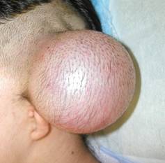 疤痕性禿頭的治療 @董哥的家 iwanthair&#039;s blog