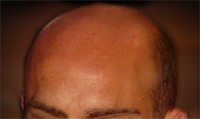 利用幹細胞可望治療禿頭 @董哥的家 iwanthair&#039;s blog
