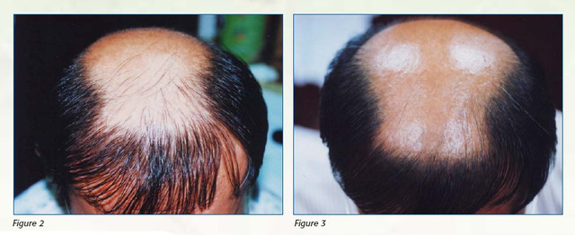 口服生育三稀酚對頭髮生長影響的臨床實驗(上) @董哥的家 iwanthair&#039;s blog