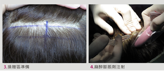 植髮經驗分享(4) @董哥的家 iwanthair&#039;s blog