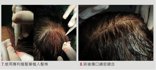植髮經驗分享(4) @董哥的家 iwanthair&#039;s blog