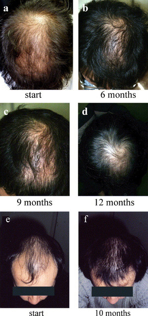 Monistat 7乳霜，一種潛在的禿頭治療方式 @董哥的家 iwanthair&#039;s blog