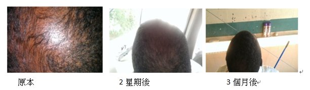 Monistat 7乳霜，一種潛在的禿頭治療方式 @董哥的家 iwanthair&#039;s blog
