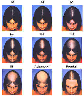 女性掉髮的分類方式 @董哥的家 iwanthair&#039;s blog