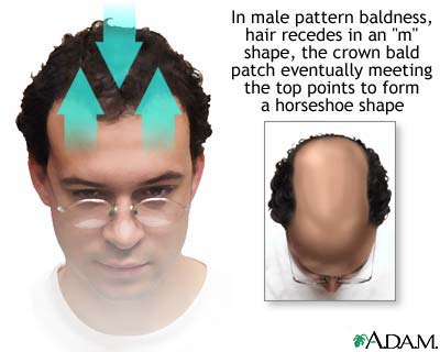雄性禿掉髮病因的研究進展(上) @董哥的家 iwanthair&#039;s blog