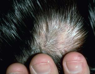 一份關於兒童掉髮的臨床研究報告 @董哥的家 iwanthair&#039;s blog