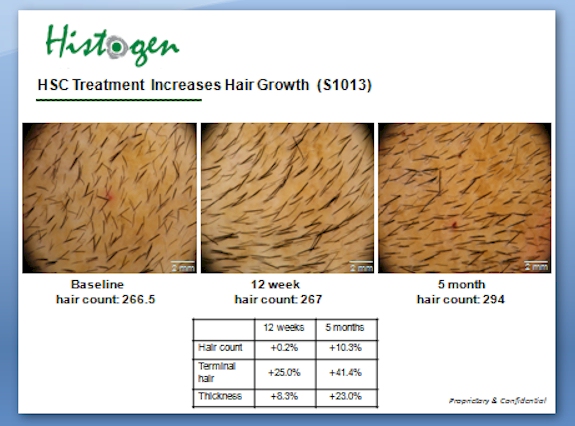 Histogen Hair Stimulating Complex (HSC) 第5個月的臨床實驗結果 @董哥的家 iwanthair&#039;s blog