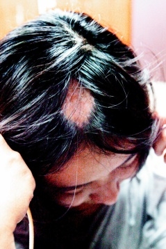 她頭頂燙禿一塊 從此無髮見人 @董哥的家 iwanthair&#039;s blog
