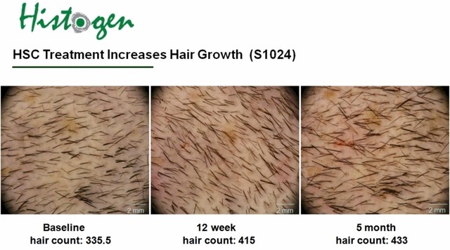 Histogen Hair Stimulating Complex (HSC) 第5個月的臨床實驗結果 @董哥的家 iwanthair&#039;s blog