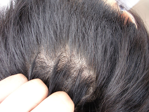 雄性禿、休止期掉髮與新冠肺炎的關聯性 @董哥的家 iwanthair&#039;s blog
