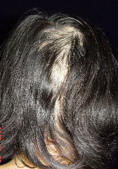 一天掉一百根頭髮 小心可能生病了 @董哥的家 iwanthair&#039;s blog