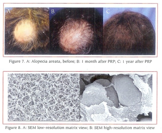 自體血小板豐富血漿(PRP)與多種生長因子應用在非植髮手術的生髮研究(下) @董哥的家 iwanthair&#039;s blog