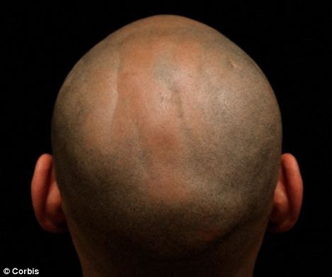 40歲前就禿頭的男性容易罹患前列腺癌 @董哥的家 iwanthair&#039;s blog