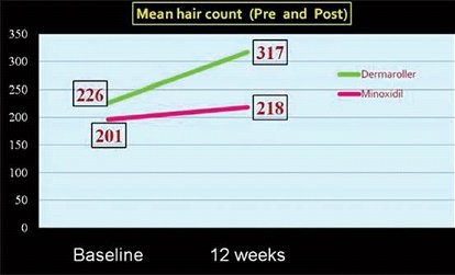 微針對雄性禿脫髮功效的隨機、評估者雙盲研究：試驗研究(中) @董哥的家 iwanthair&#039;s blog