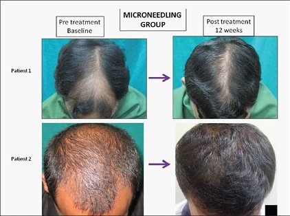 微針對雄性禿脫髮功效的隨機、評估者雙盲研究：試驗研究(下) @董哥的家 iwanthair&#039;s blog