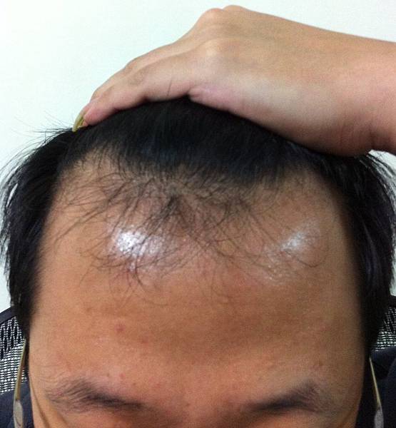 植髮經驗分享(7) @董哥的家 iwanthair&#039;s blog