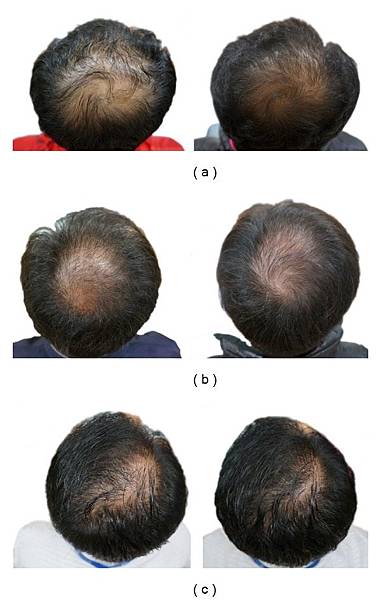 南瓜籽油對男性雄性禿脫髮的頭髮生長影響評估：一項隨機、雙盲、安慰劑對照試驗(中) @董哥的家 iwanthair&#039;s blog