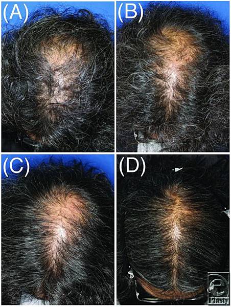 運用脂肪幹細胞條件培養基的毛髮再生治療 @董哥的家 iwanthair&#039;s blog