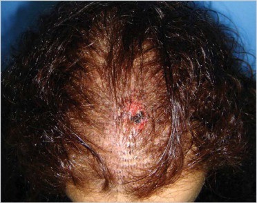 植髮手術的可能併發症 @董哥的家 iwanthair&#039;s blog