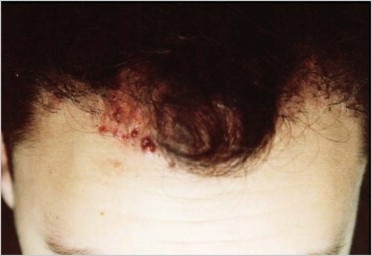 植髮手術的可能併發症 @董哥的家 iwanthair&#039;s blog