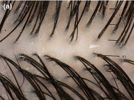 毛髮鏡檢查-最簡易的自我落髮檢查工具 @董哥的家 iwanthair&#039;s blog